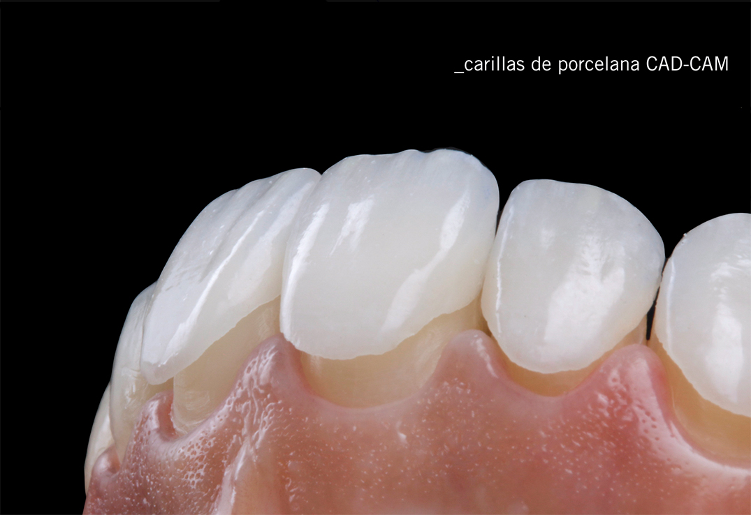 Estética dental: carillas de porcelana 