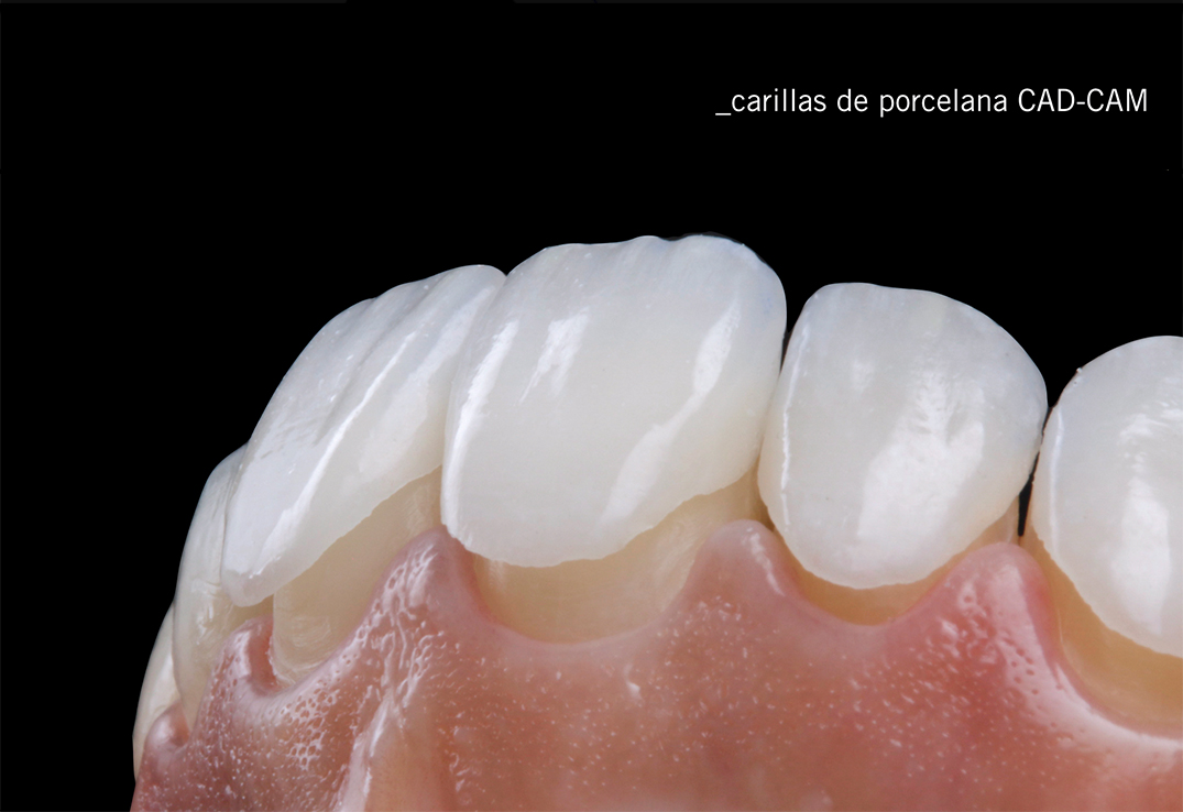 Carillas Dentales en Countryside, IL, Carilla de Porcelana