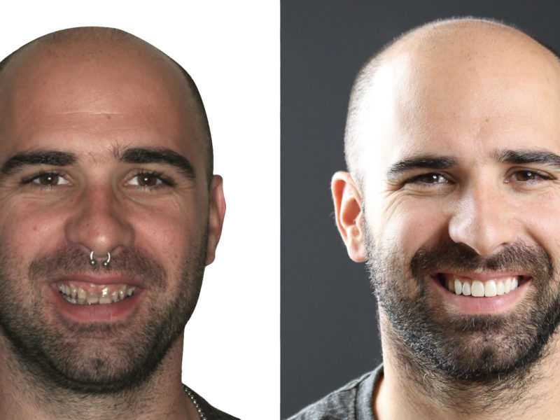 Antes y después de Josep - Resultados impresionantes en la Clínica Dental Berbís Estela en Castellón