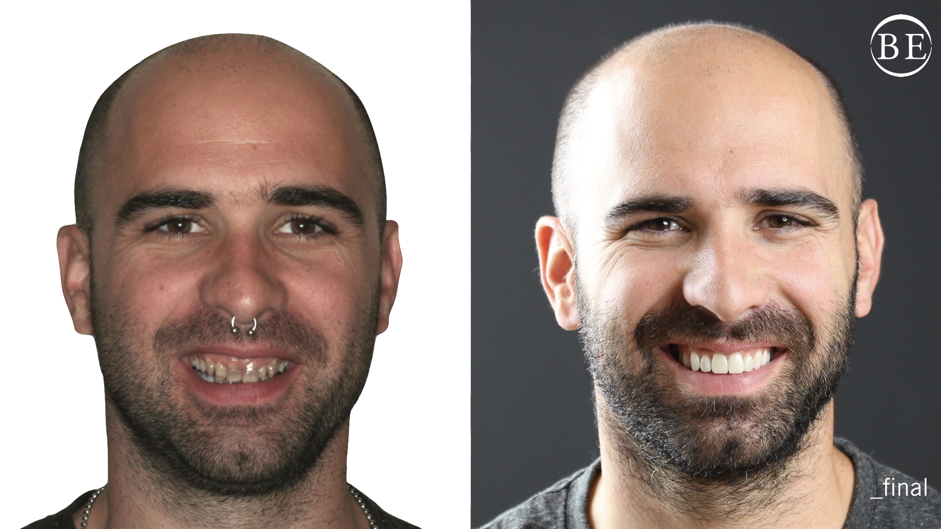 Antes y después de Josep - Resultados impresionantes en la Clínica Dental Berbís Estela en Castellón