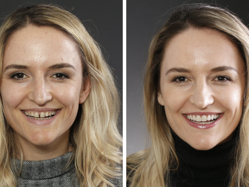 Antes y después de Majlinda - Resultados sorprendentes en la Clínica Dental Berbís Estela en Castellón