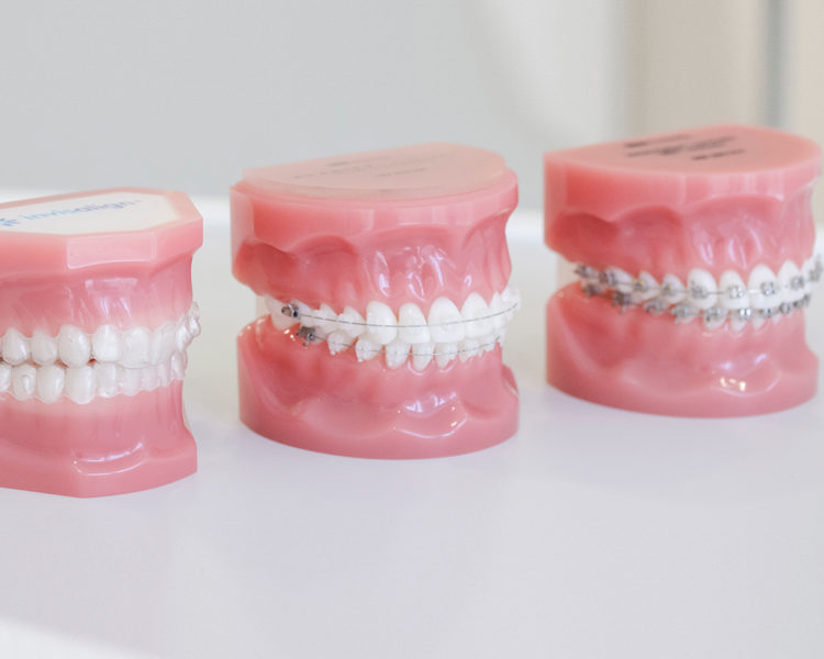 Ortodoncia en Castellón: Tipos de ortodoncia en Clínica Berbís Estela