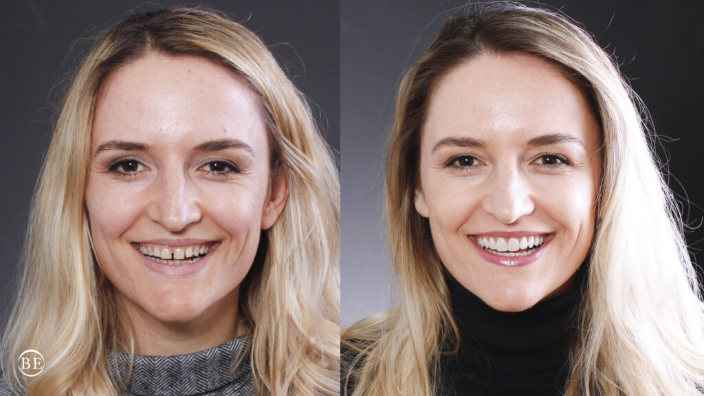 Tratamiento de Carillas dentales en Castellón