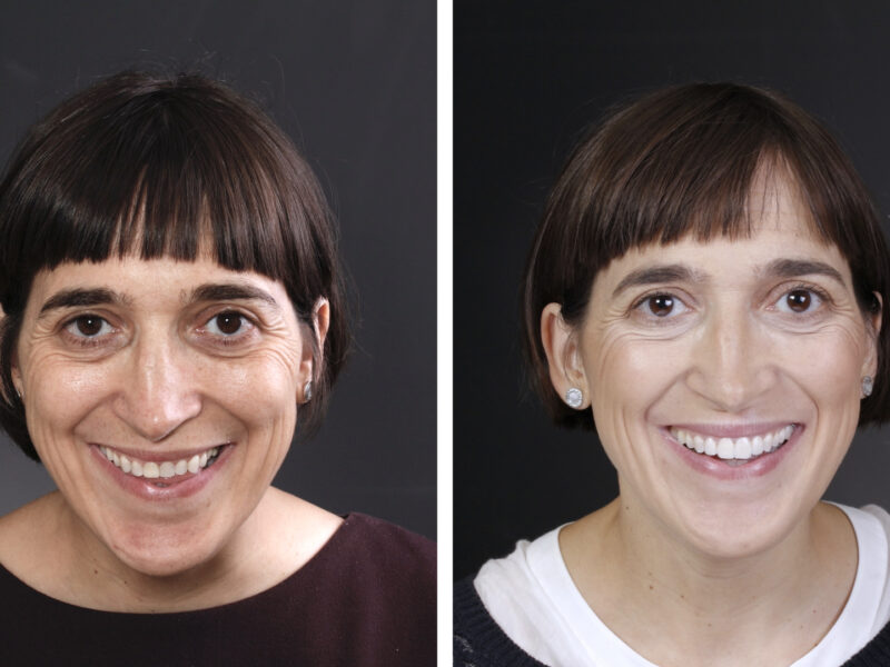 Antes y después de Belén - Resultados sorprendentes en la Clínica Berbís Estela, Clínica dental en Castellón