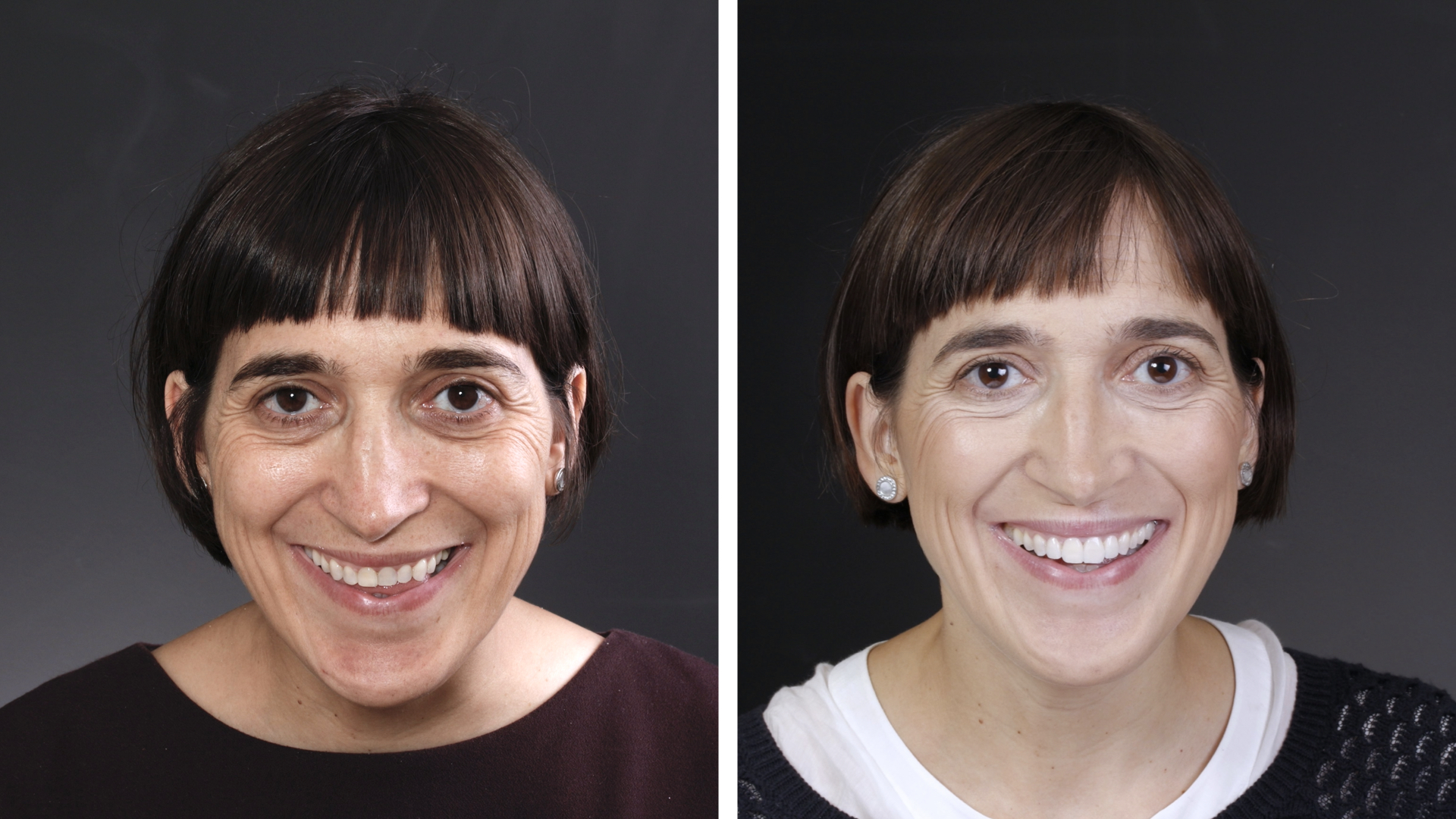 Antes y después de Belén - Resultados sorprendentes en la Clínica Berbís Estela, Clínica dental en Castellón