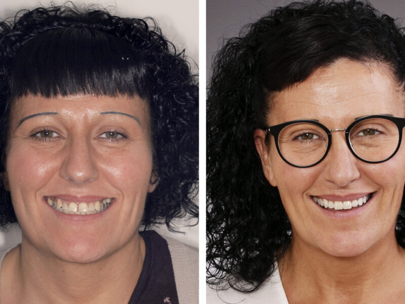 Antes y después de Tere - Resultados notables en la Clínica Berbís Estela, Clínica dental en Castellón