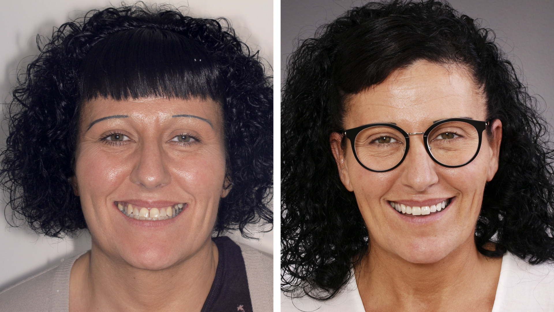 Antes y después de Tere - Resultados notables en la Clínica Berbís Estela, Clínica dental en Castellón