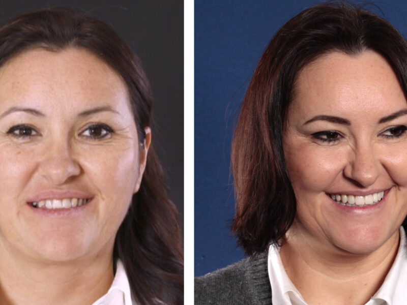 Transformación estética con carillas dentales en Clínica Berbís Estela, Castellón